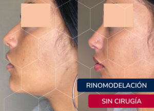 rinomodelación sin cirugia