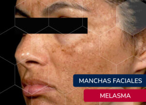 manchas faciales melasma