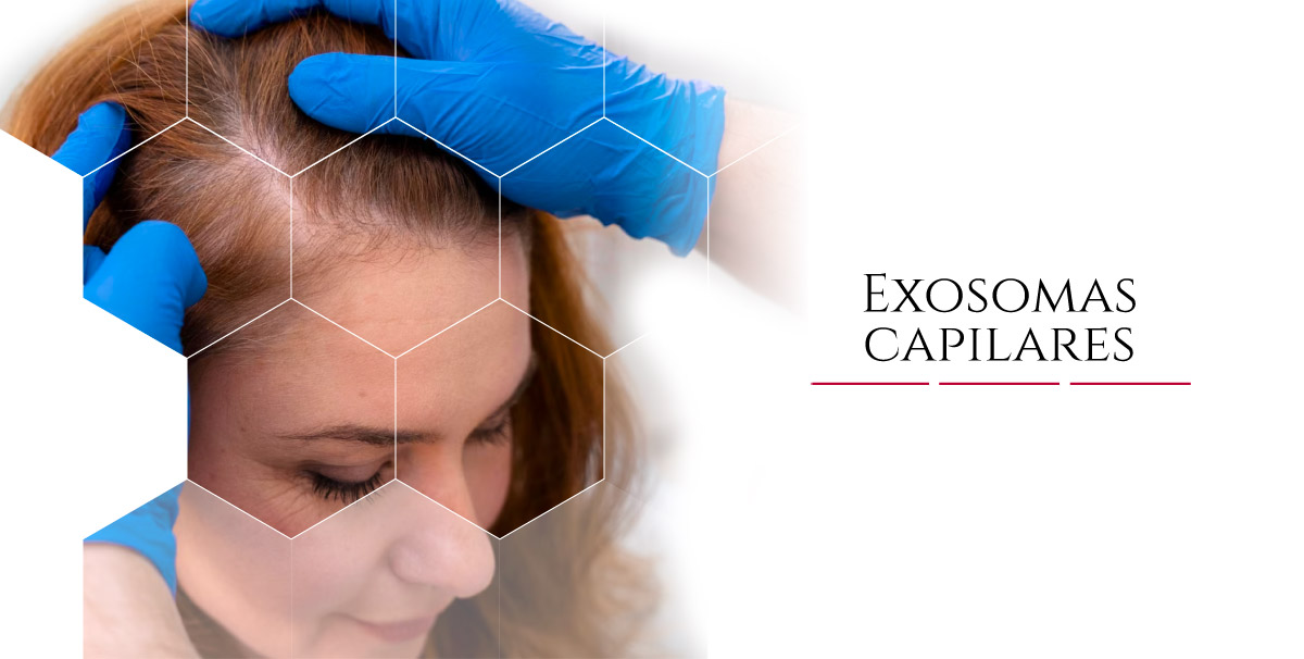 exosomas capilares, tratamiento para la caida del cabello hombres y mujeres