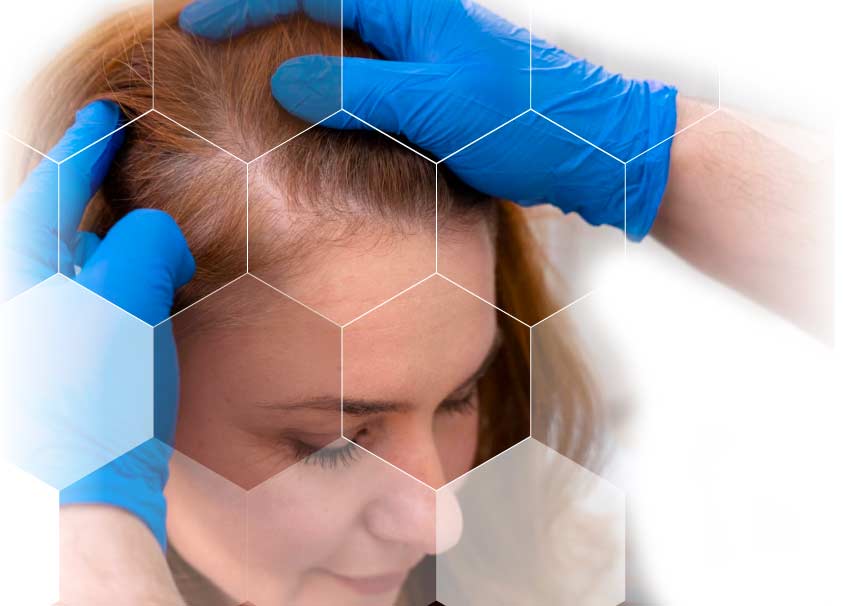 exosomas capilares, tratamiento alopecia hombre y mujeres